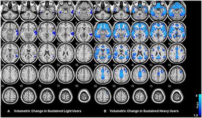 Heavy Drinking in College Students Is Associated with Accelerated Gray Matter Volumetric Decline over a 2 Year Period